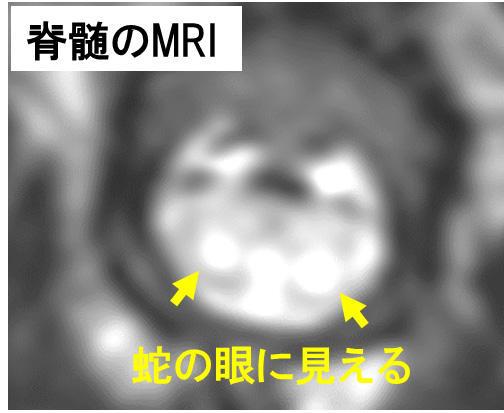 脊髄疾患症例への投与③