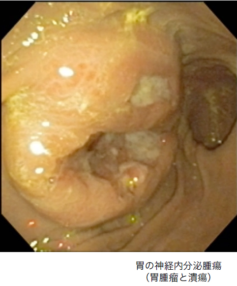 内視鏡検査（上部消化管・下部消化管）