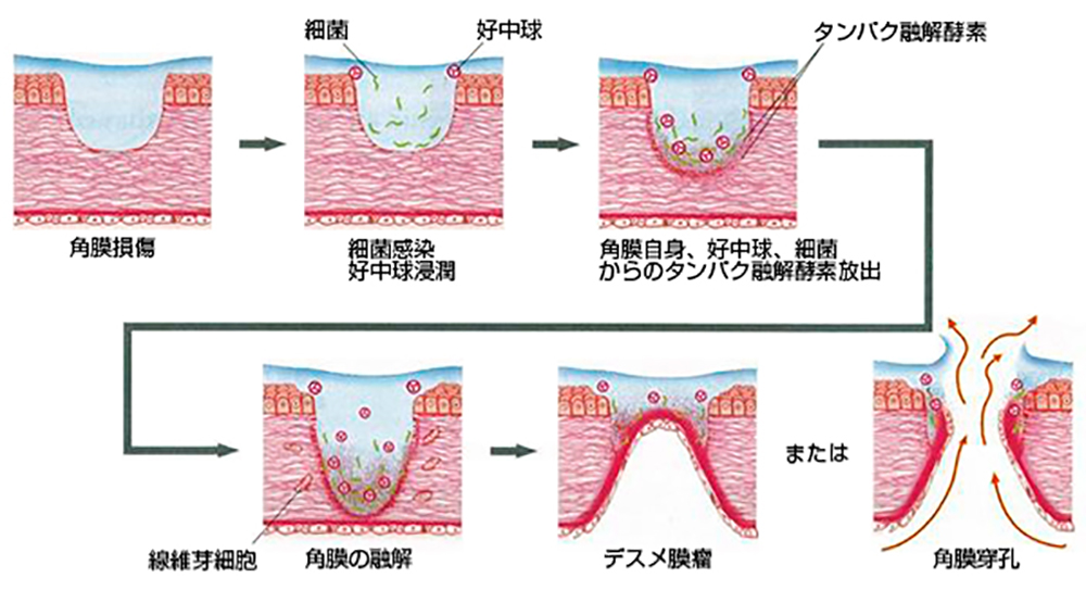 角膜潰瘍の進行