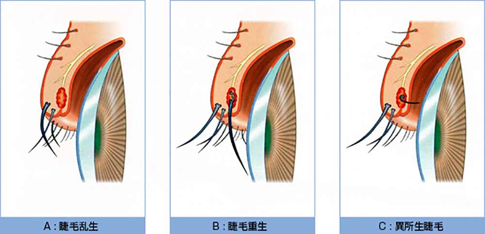 角膜前涙液層構造