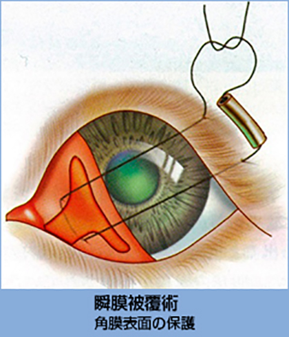 瞬膜被覆術