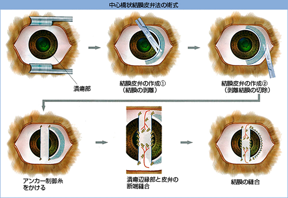 中心橋状結膜皮弁法の術式