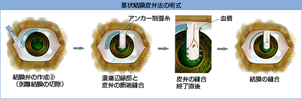 茎状結膜皮弁法の術式