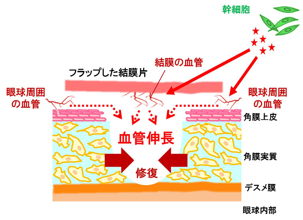 角膜損傷症例への間葉系幹細胞投与①